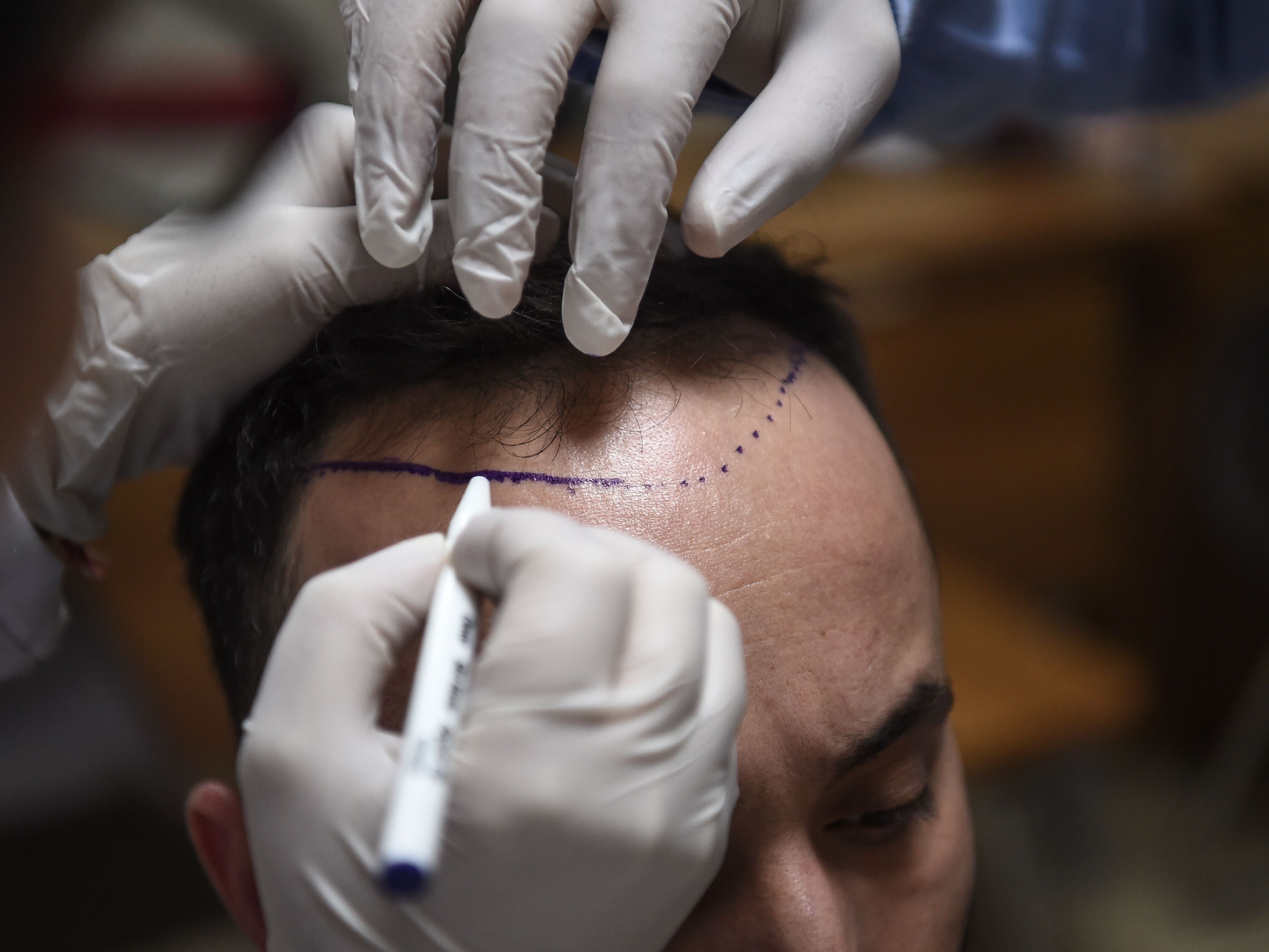 caption: With hundreds of clinics specialized in hair transplants, Istanbul is a growing hub in the industry, attracting people from all over the world.