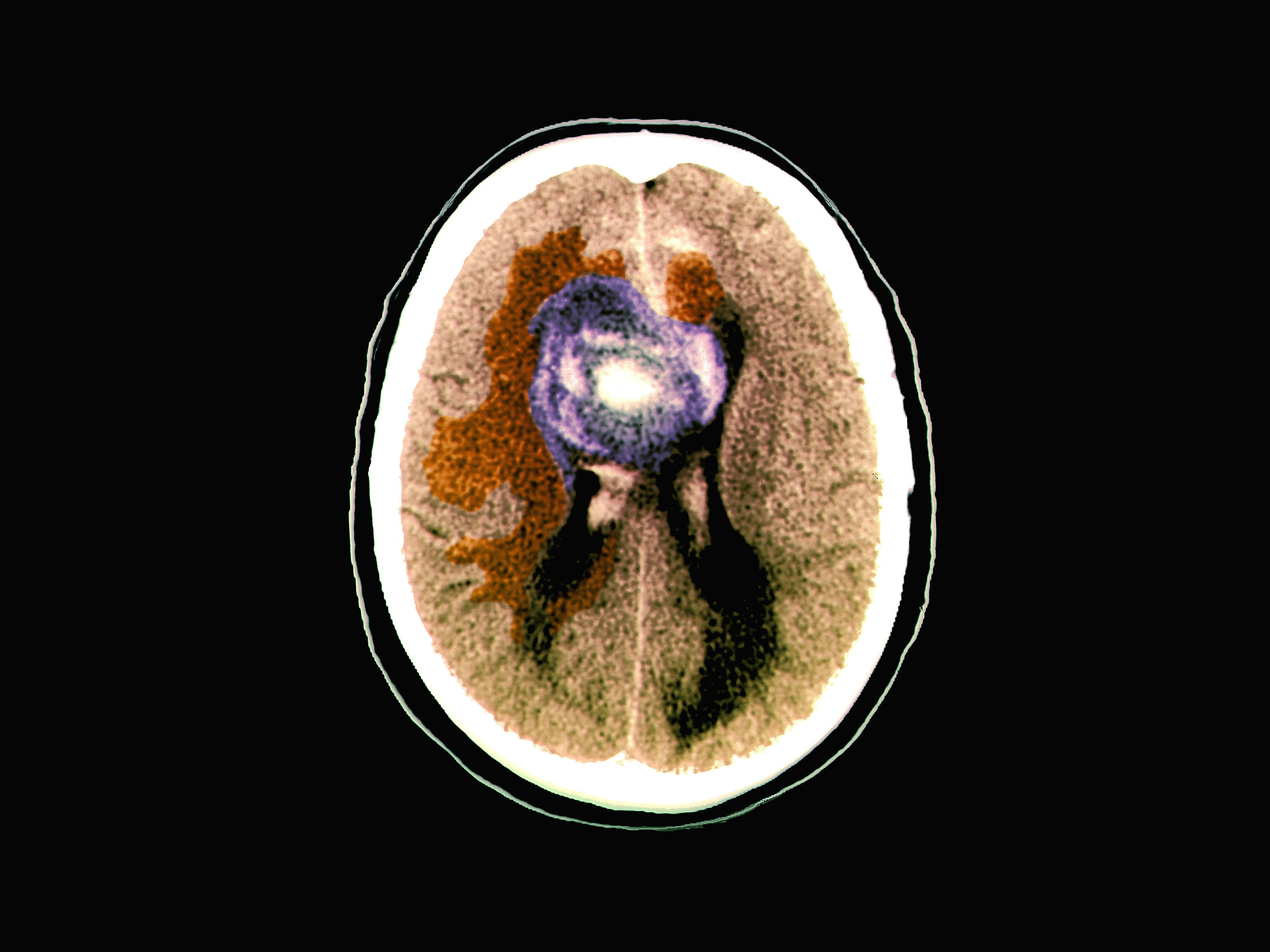 caption: A colored computerized tomography (CT) scan of an axial section of the brain of a 59-year-old patient with a malignant (cancerous) glioblastoma brain tumor.