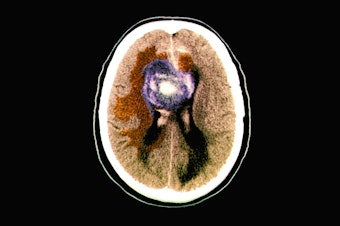 caption: A colored computerized tomography (CT) scan of an axial section of the brain of a 59-year-old patient with a malignant (cancerous) glioblastoma brain tumor.