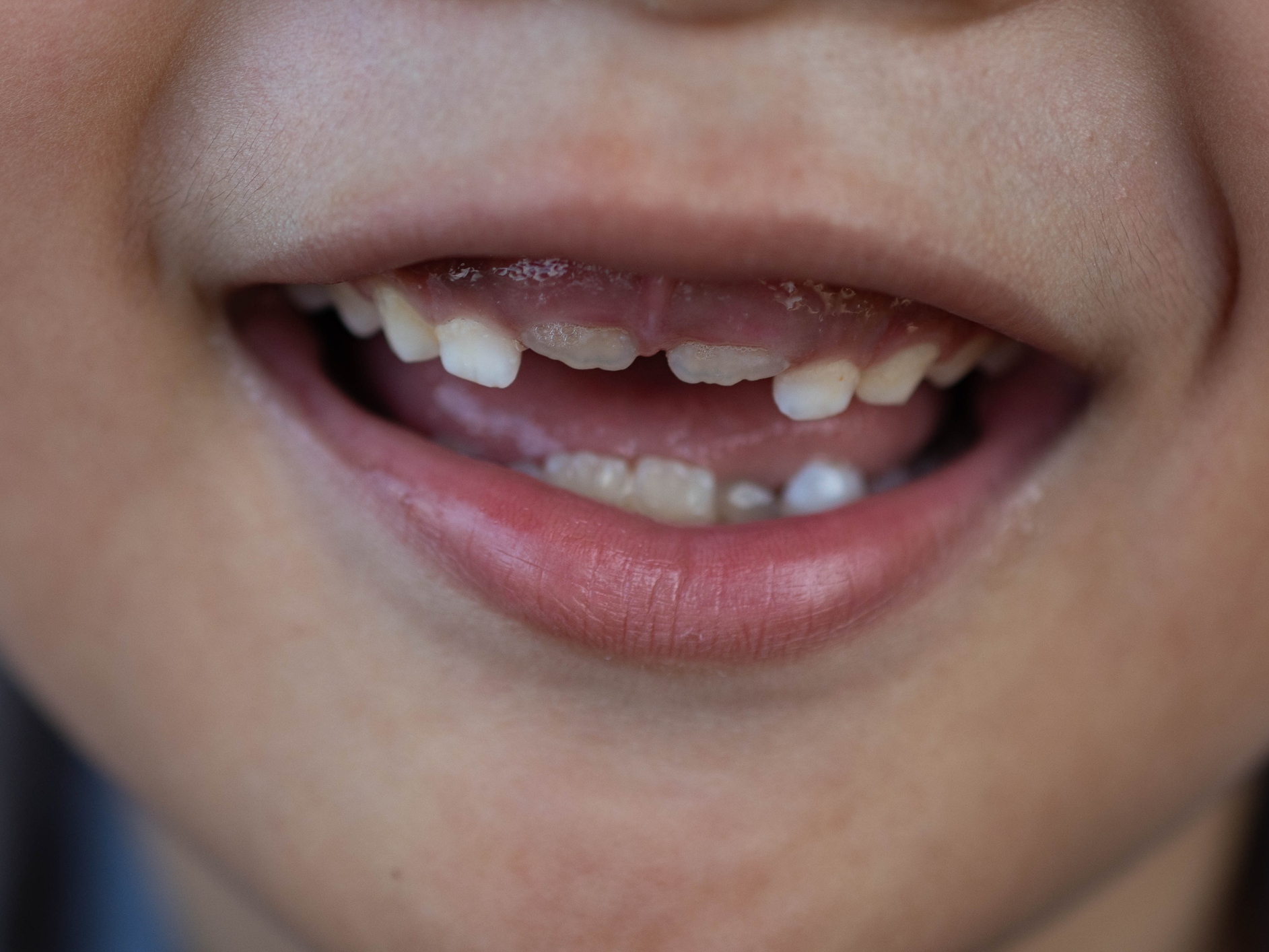 caption: Dentists sometimes prescribe fluoride supplements to kids in areas that lack water fluoridation. FDA is taking action to remove such treatments from the market.
