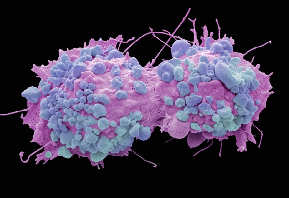 caption: Colored scanning electron micrograph of dividing ovarian cancer cells.