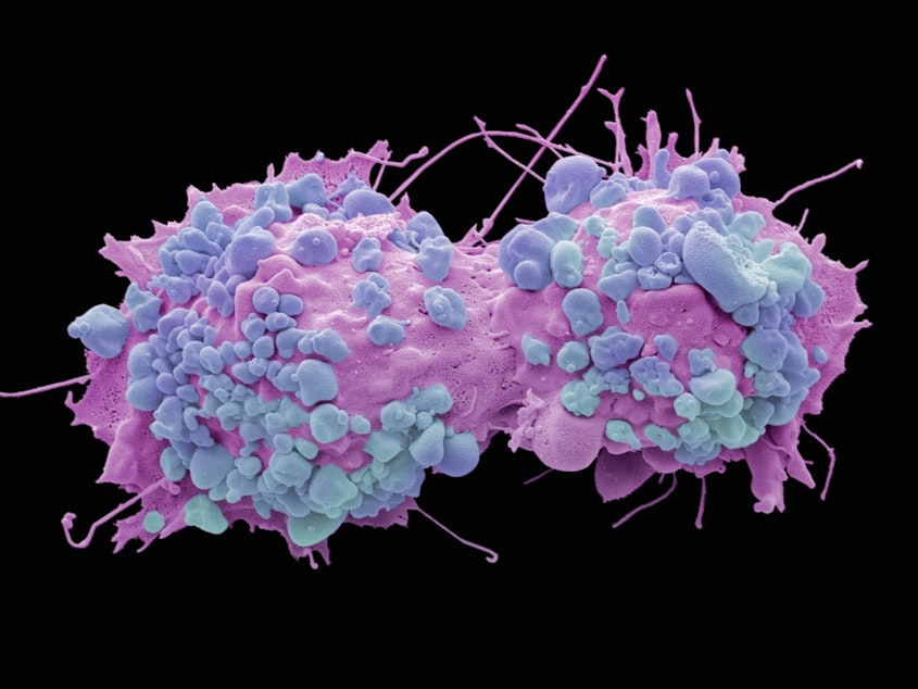 caption: Colored scanning electron micrograph of dividing ovarian cancer cells.