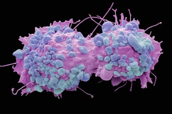 caption: Colored scanning electron micrograph of dividing ovarian cancer cells.