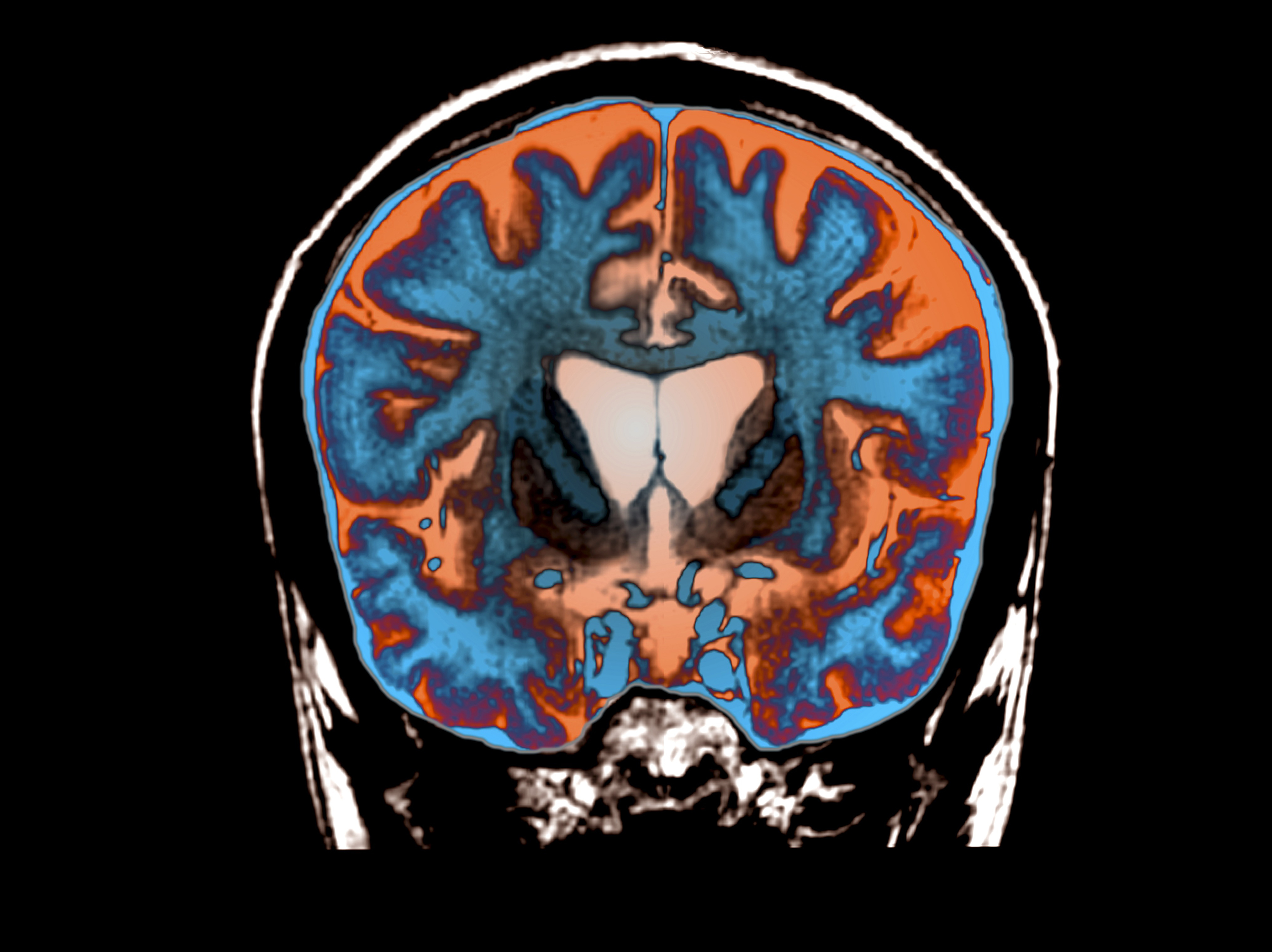 caption: An MRI scan shows signs of atrophy in the brain of a patient with Huntington's disease.