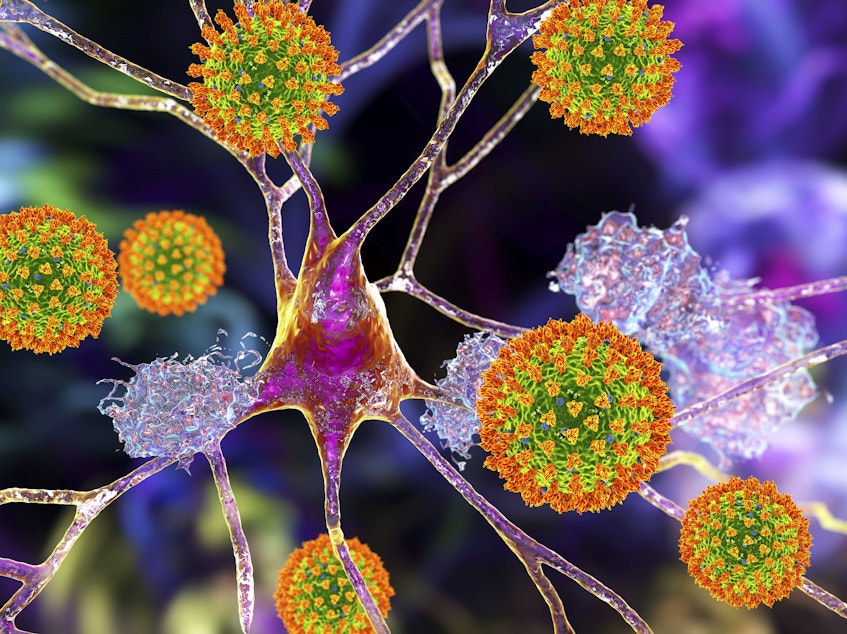 caption: Researchers are learning that the coronavirus can infect neurons and may cause lasting damage in some cases.