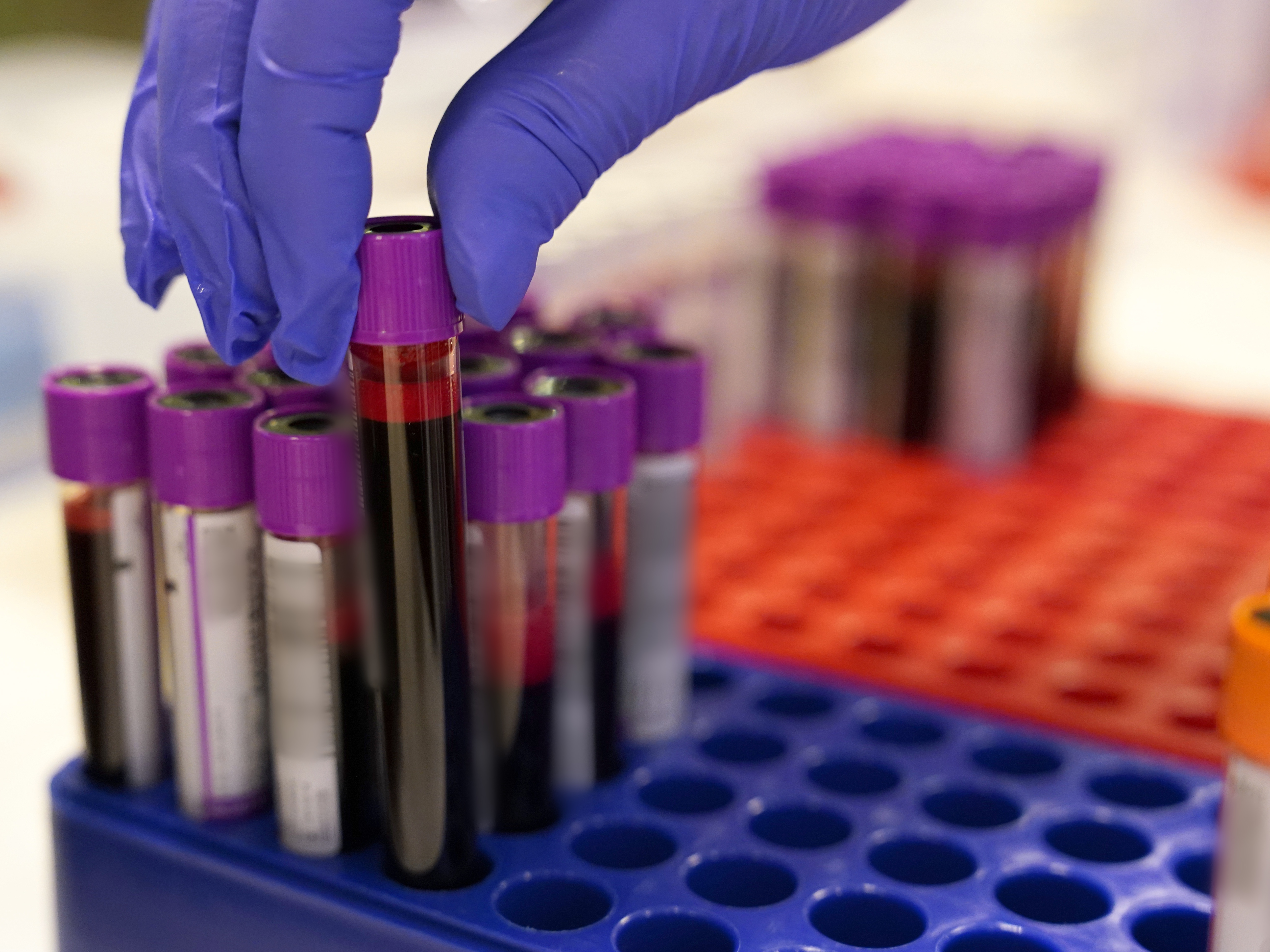 caption: New blood tests that help detect Alzheimer's disease are opening up a new era in diagnosis and treatment, doctors say.  