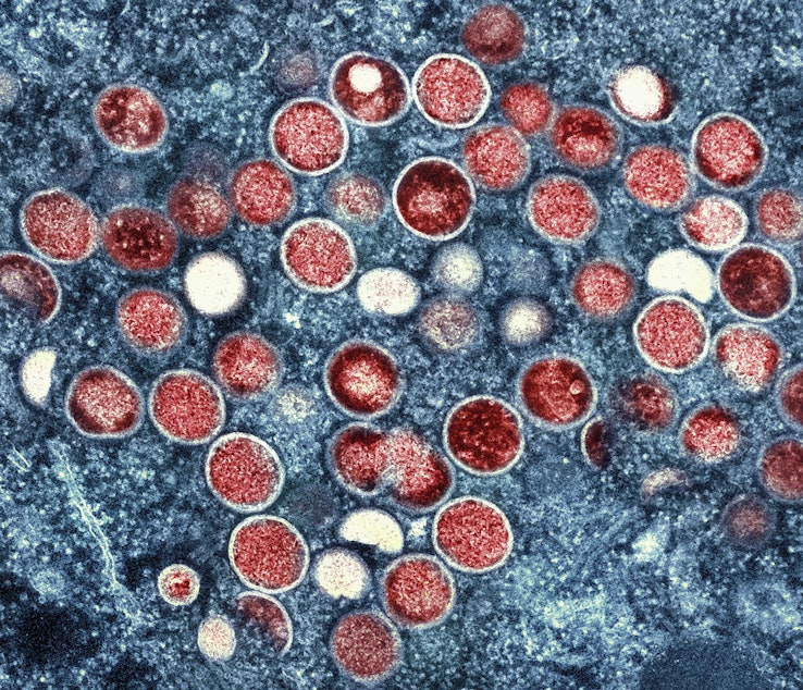 caption: This image provided by the National Institute of Allergy and Infectious Diseases (NIAID) shows a colorized transmission electron micrograph of monkeypox particles (red) found within an infected cell (blue), cultured in the laboratory that was captured and color-enhanced at the NIAID Integrated Research Facility (IRF) in Fort Detrick, Md.