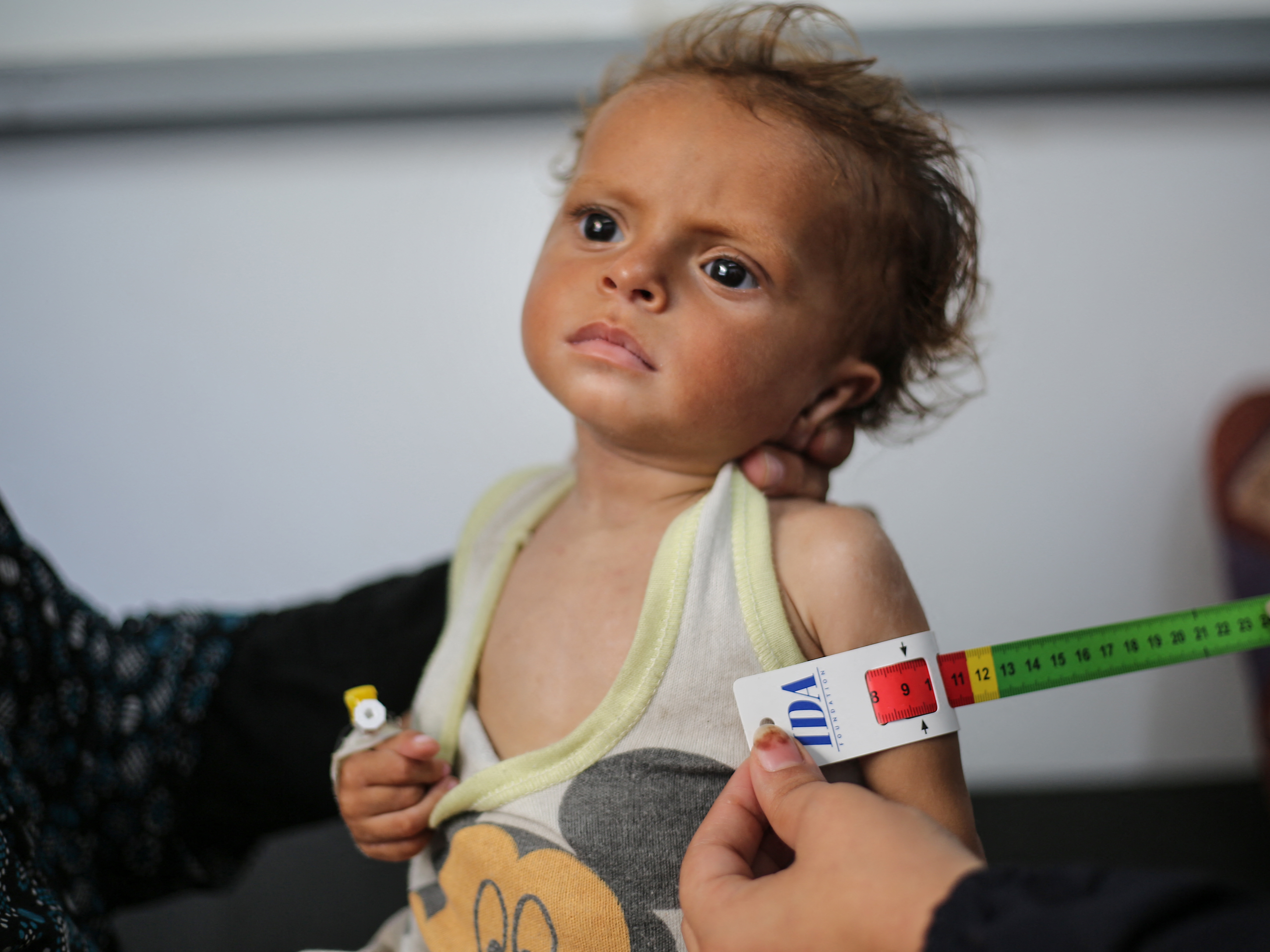 caption: A malnourished Palestinian child is examined at a Gaza hospital. A U.N.-backed panel has now declared that famine is underway in northern Gaza and warned it could extend to central and southern Gaza by late September.