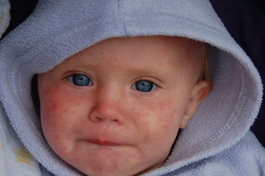 caption: FILE: A child with measles