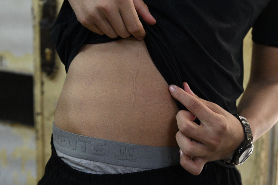 caption: A young man shares a wound he says he received from a soldier during a raid in a camp.