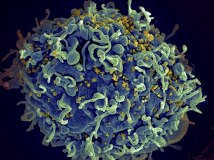 caption: This electron microscope image made available by the U.S. National Institutes of Health shows a human T cell, in blue, under attack by HIV, in yellow, the virus that causes AIDS.