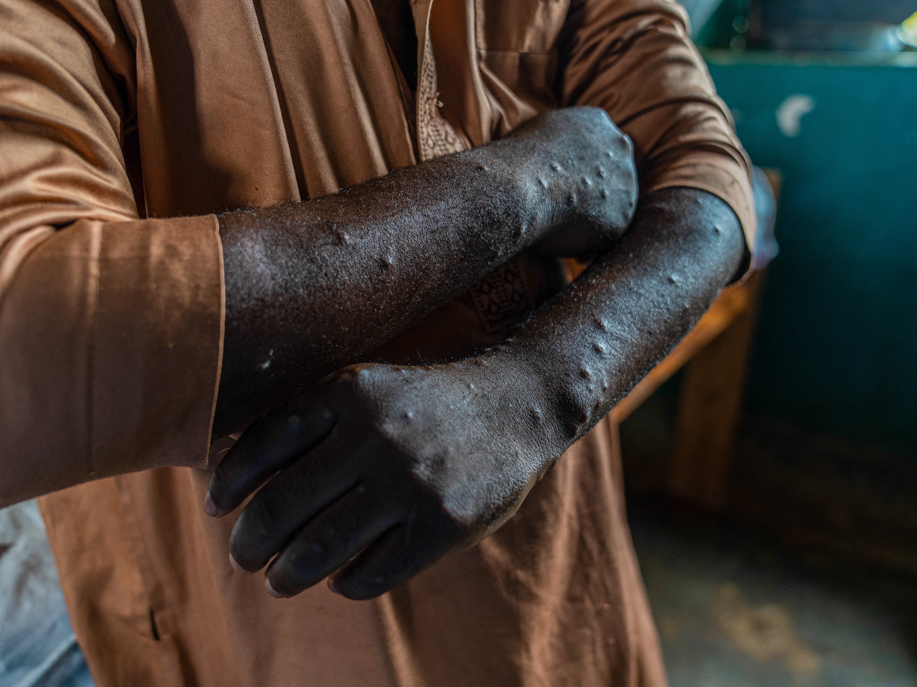 caption: Lesions can be seen on this mpox patient in the Democratic Republic of Congo, the epicenter of an outbreak in Africa.