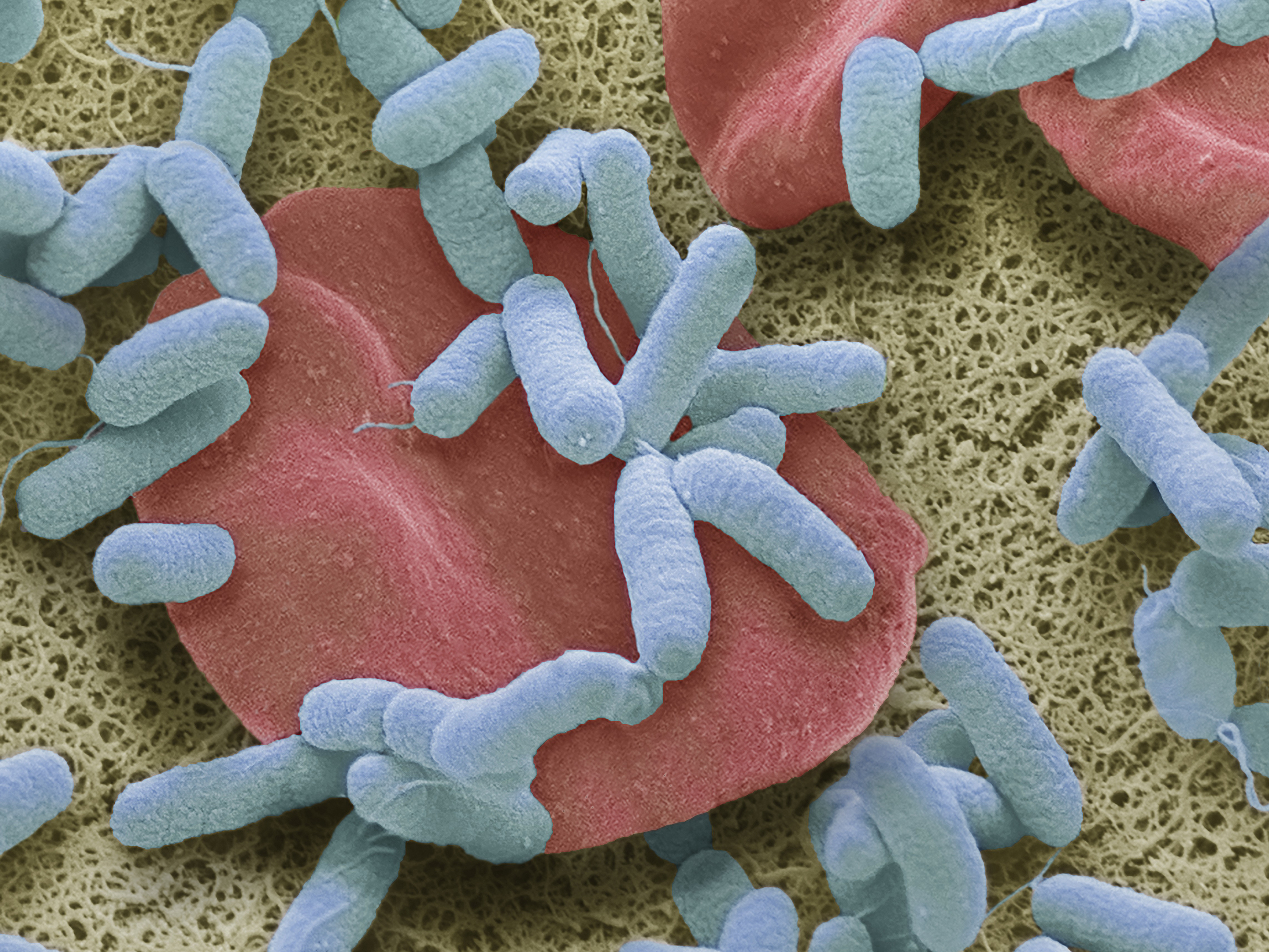 caption: Sepsis, or blood poisoning, occurs when the body overreacts to infection. It's a leading cause of death worldwide.