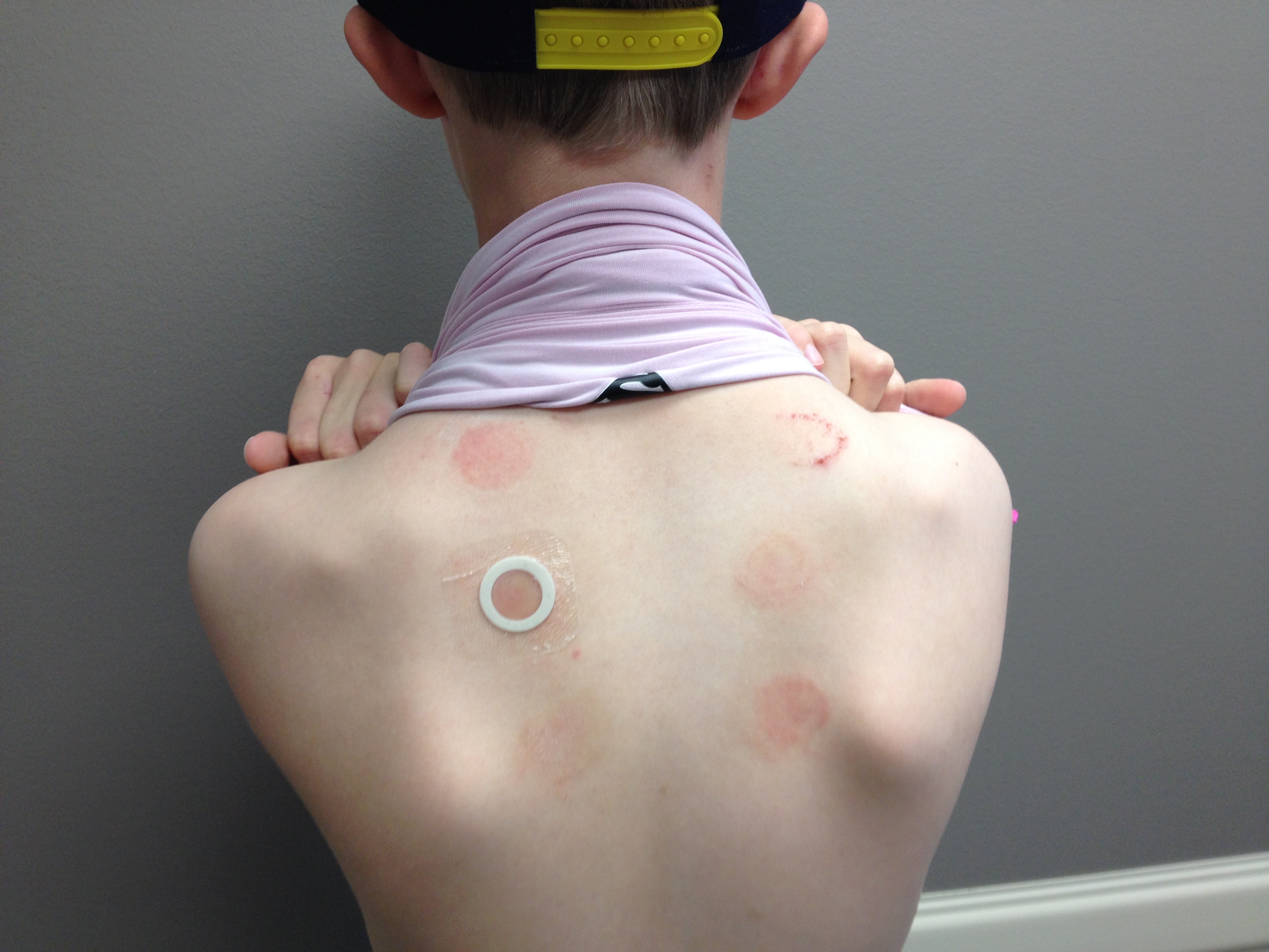 caption: The trial involves wearing a skin patch that contains a small amount of peanut protein. 