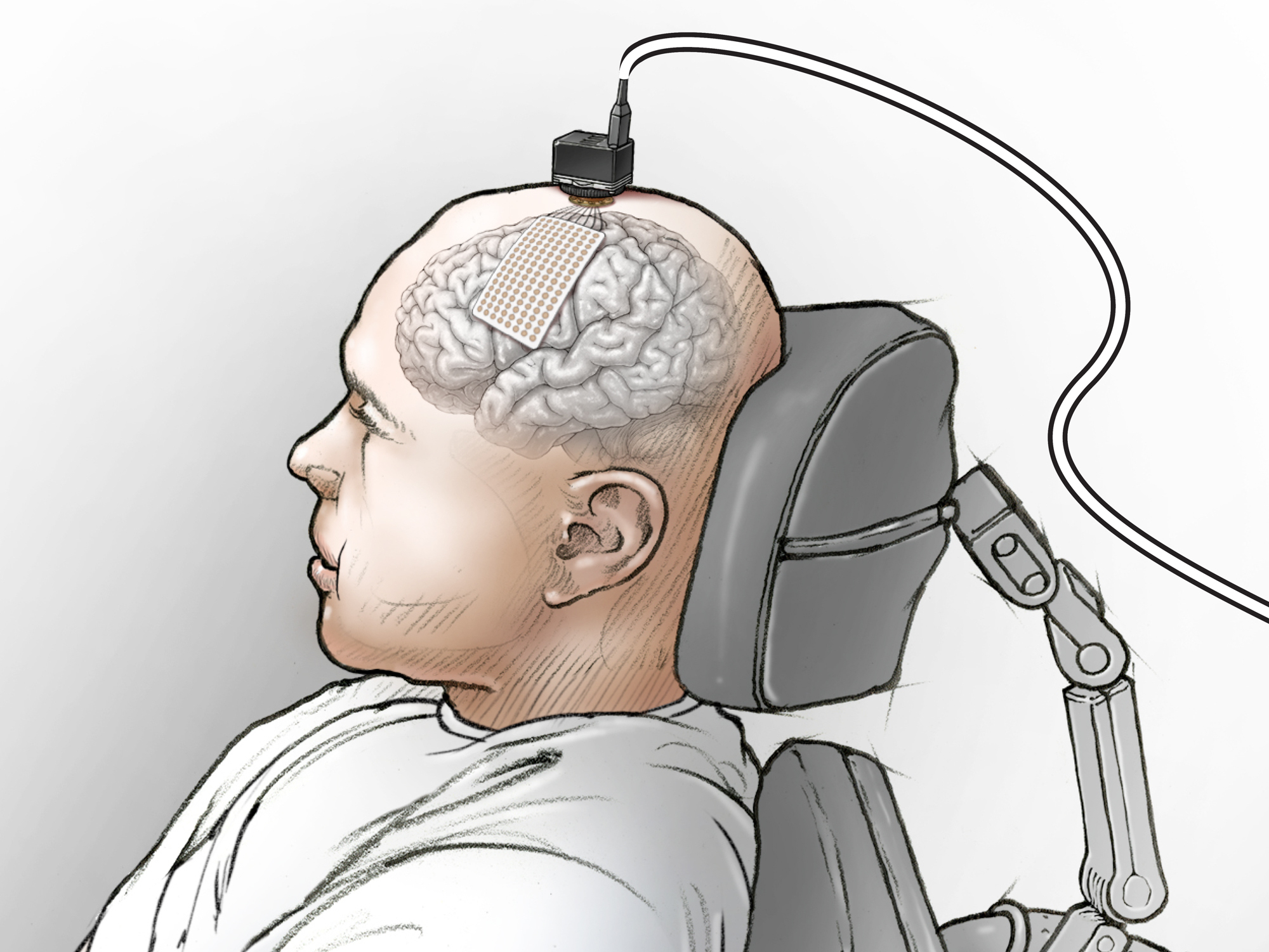 caption: Illustration showing placement of the eCOG electrode on the participant's speech motor cortex and the head stages used to connect the electrode to the computer.