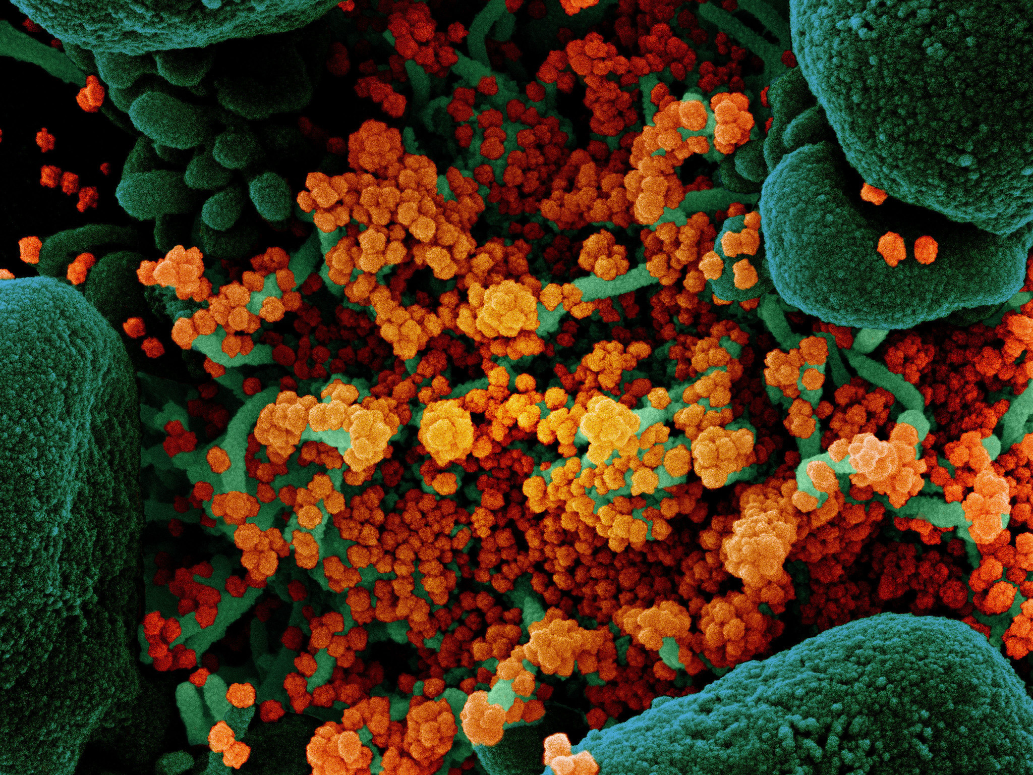 caption: A colorized scanning electron micrograph of a cell (green) heavily infected with particles (orange) from the virus that causes COVID-19, isolated from a patient sample.