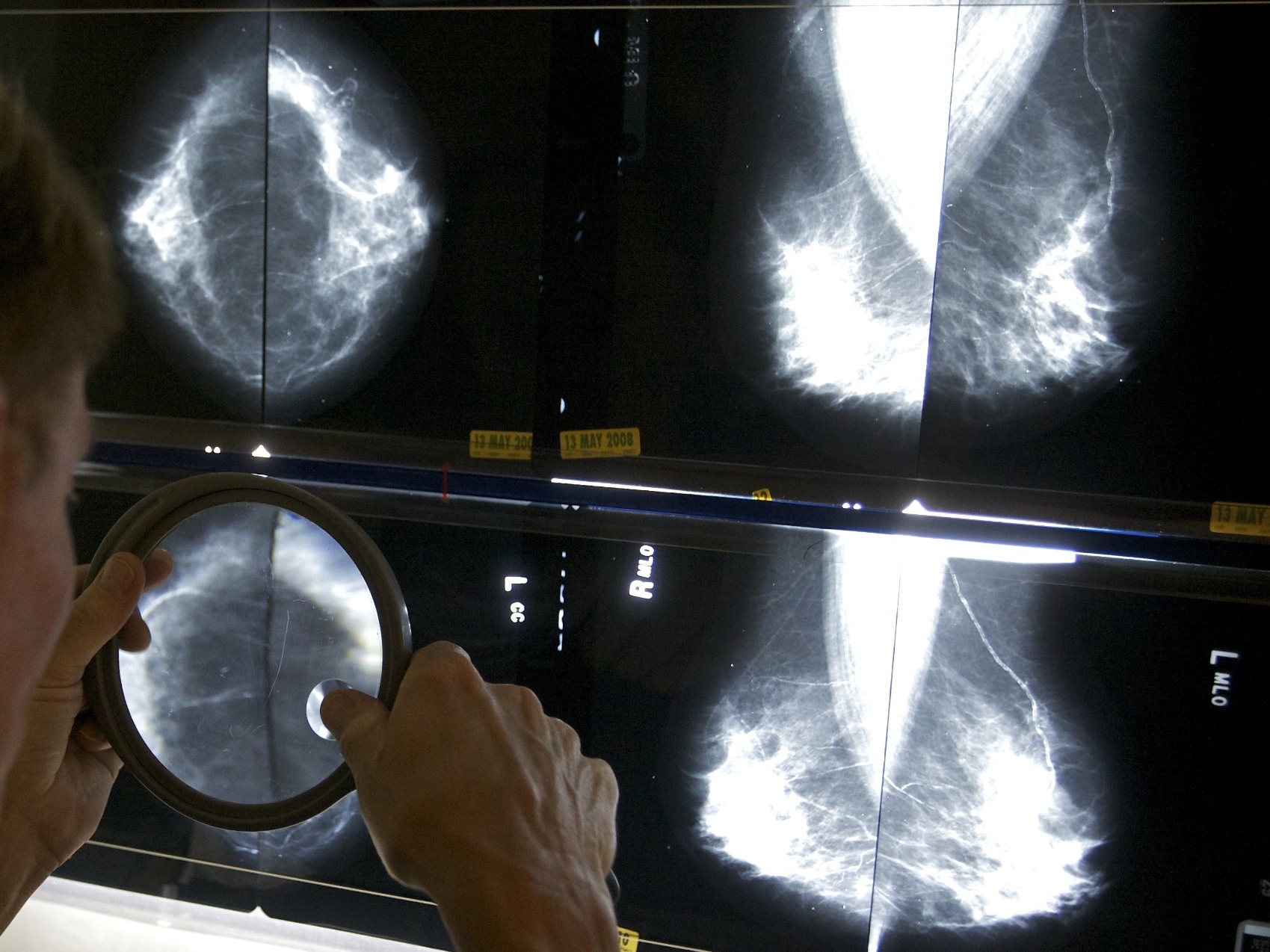 caption: A radiologist uses a magnifying glass to check mammograms for breast cancer.  Breast density is a risk factor for cancer.