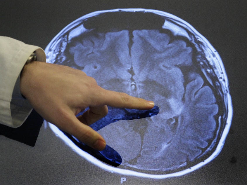 caption: Dr. Paul Nyquist points to spots of possible damage caused by a stroke brain scan. Over the past 30 years, strokes among adults 49 and younger have increased in some parts of the U.S.