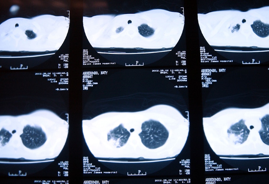 caption: X-rays of a patient with tuberculosis, taken in November 2002 in New Jersey, show damage to the lungs.