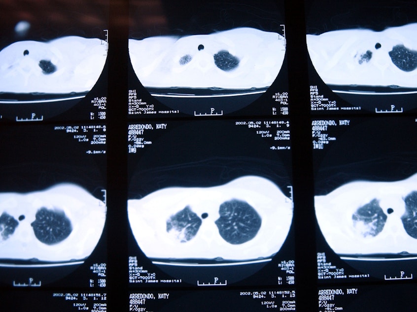 caption: X-rays of a patient with tuberculosis, taken in November 2002 in New Jersey, show damage to the lungs.