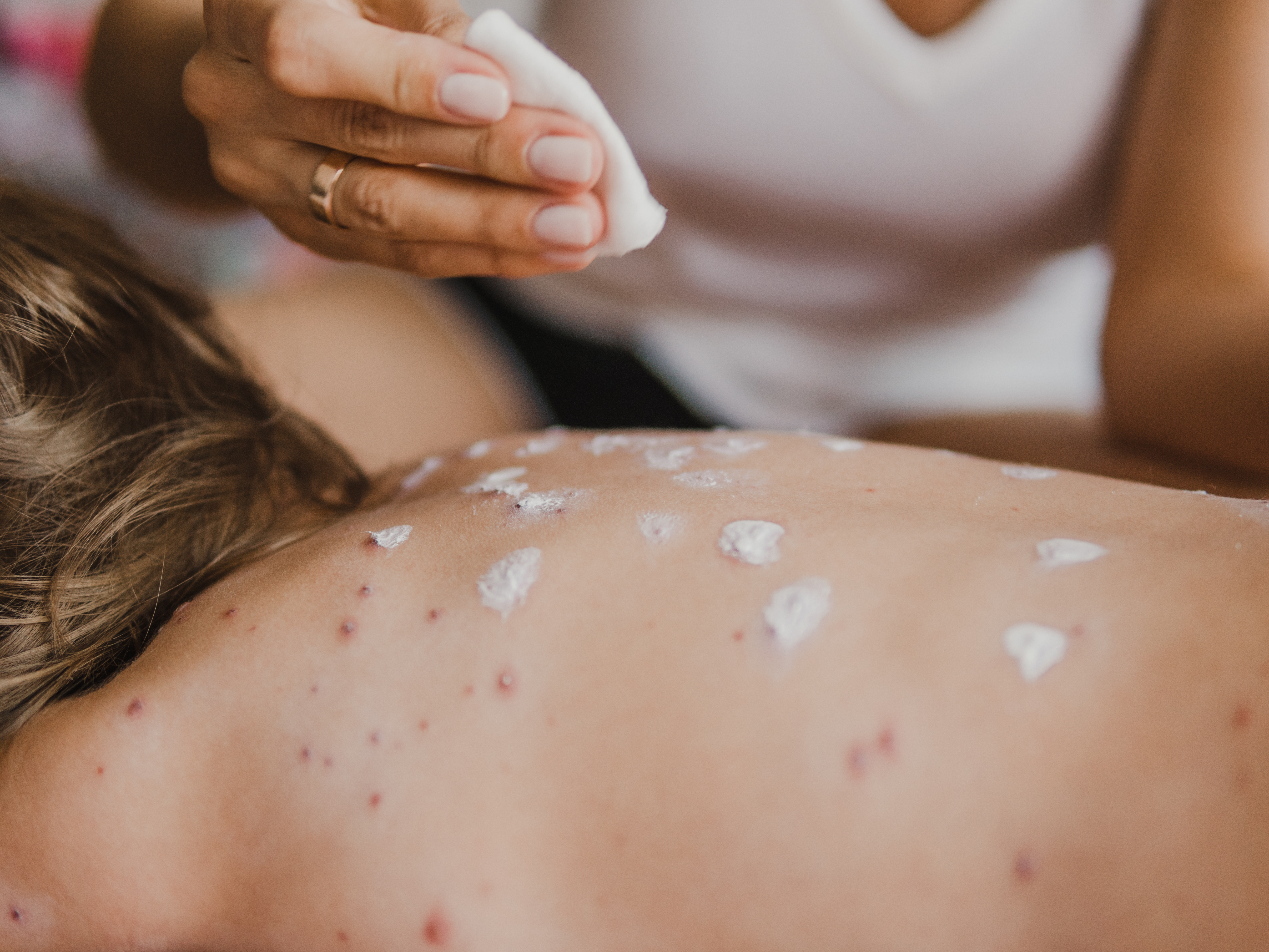 caption: At least 36 students at a North Carolina school have become infected with chickenpox. The school has many students whose parents claimed a religious exemption from state vaccination requirements.