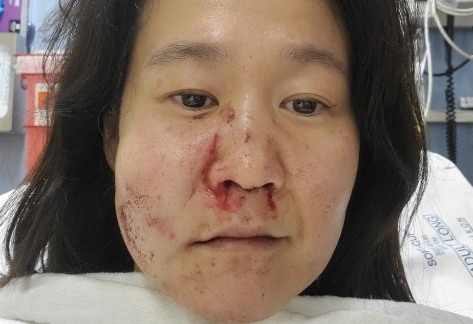 caption: Noriko Nasu, 44, in the hospital after she was attacked by a man in the Chinatown-International District. Nasu believes it was a hate crime.