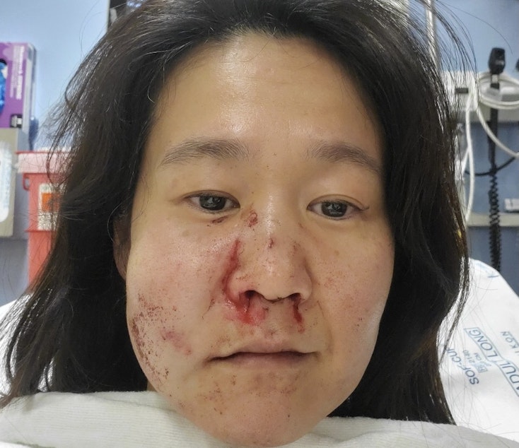 caption: Noriko Nasu, 44, in the hospital after she was attacked by a man in the Chinatown-International District. Nasu believes it was a hate crime.