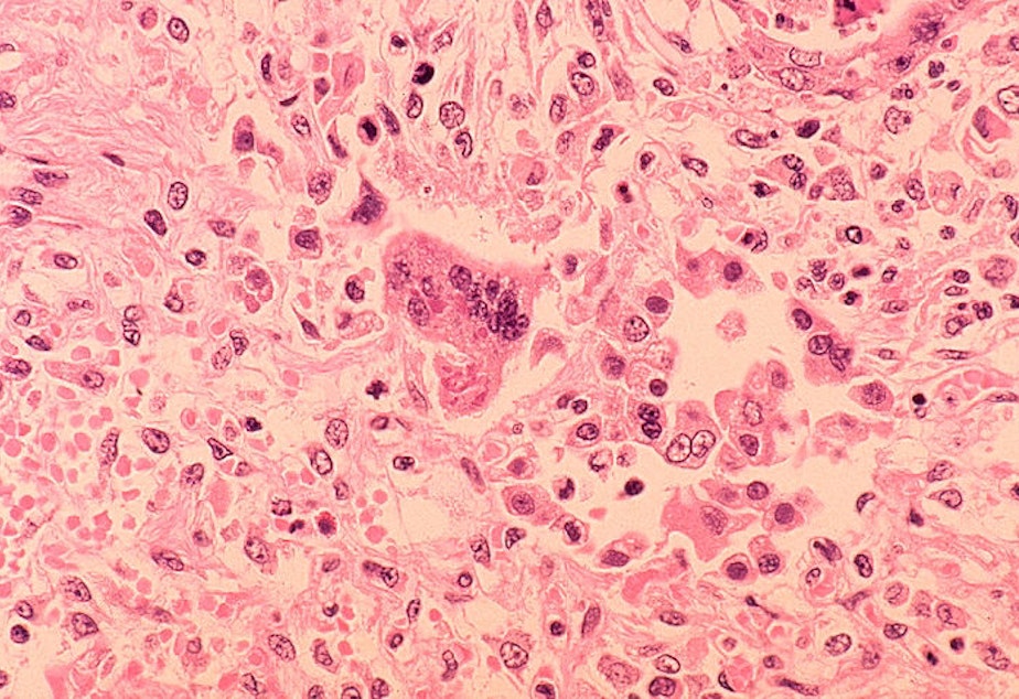 The measles virus.