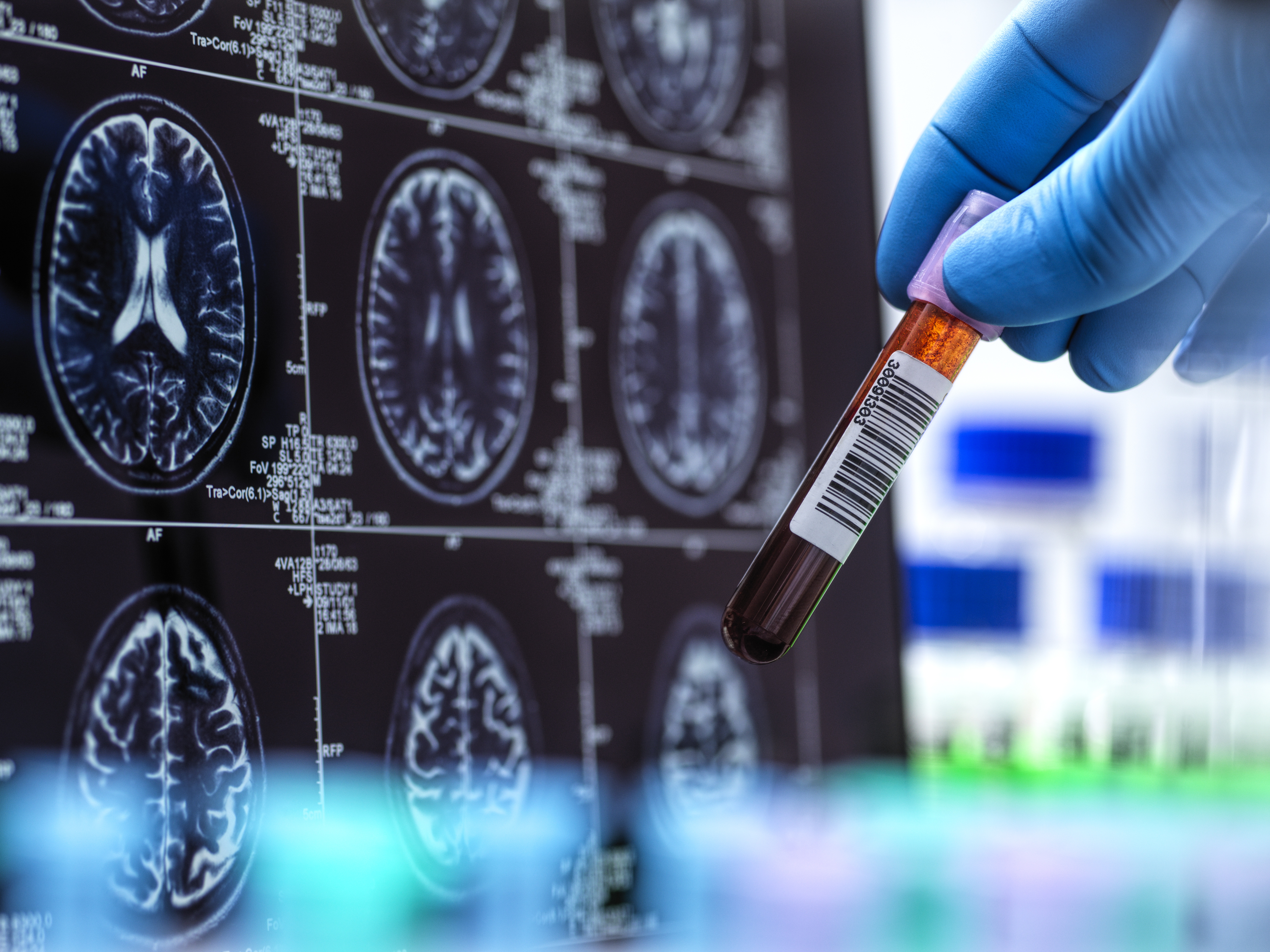 caption: The first Alzheimer's blood test cleared by the Food And Drug Administration is set to make diagnosis more accessible and accurate — and change the way doctors treat the disease.