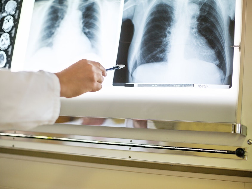 caption: Patients hospitalized with vaping-related illness often have severe pneumonia, and this kind of inflammation can create long-term damage, doctors say.