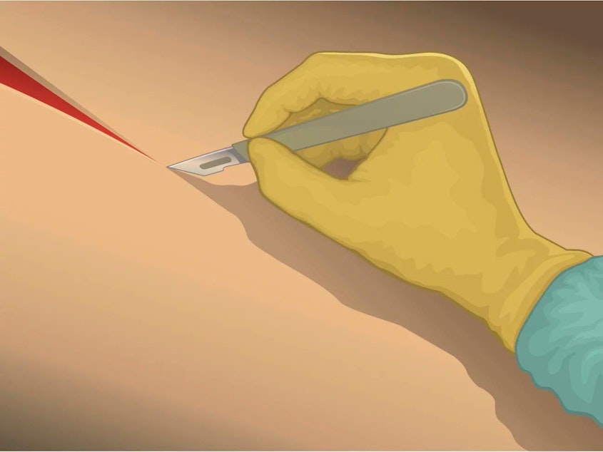 caption: Approximately one in every three births in the U.S. occurs as the result of a C-section.