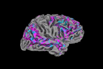 caption: This video still shows a view of one person's cerebral cortex. Pink areas have above-average activity; blue areas have below-average activity.
