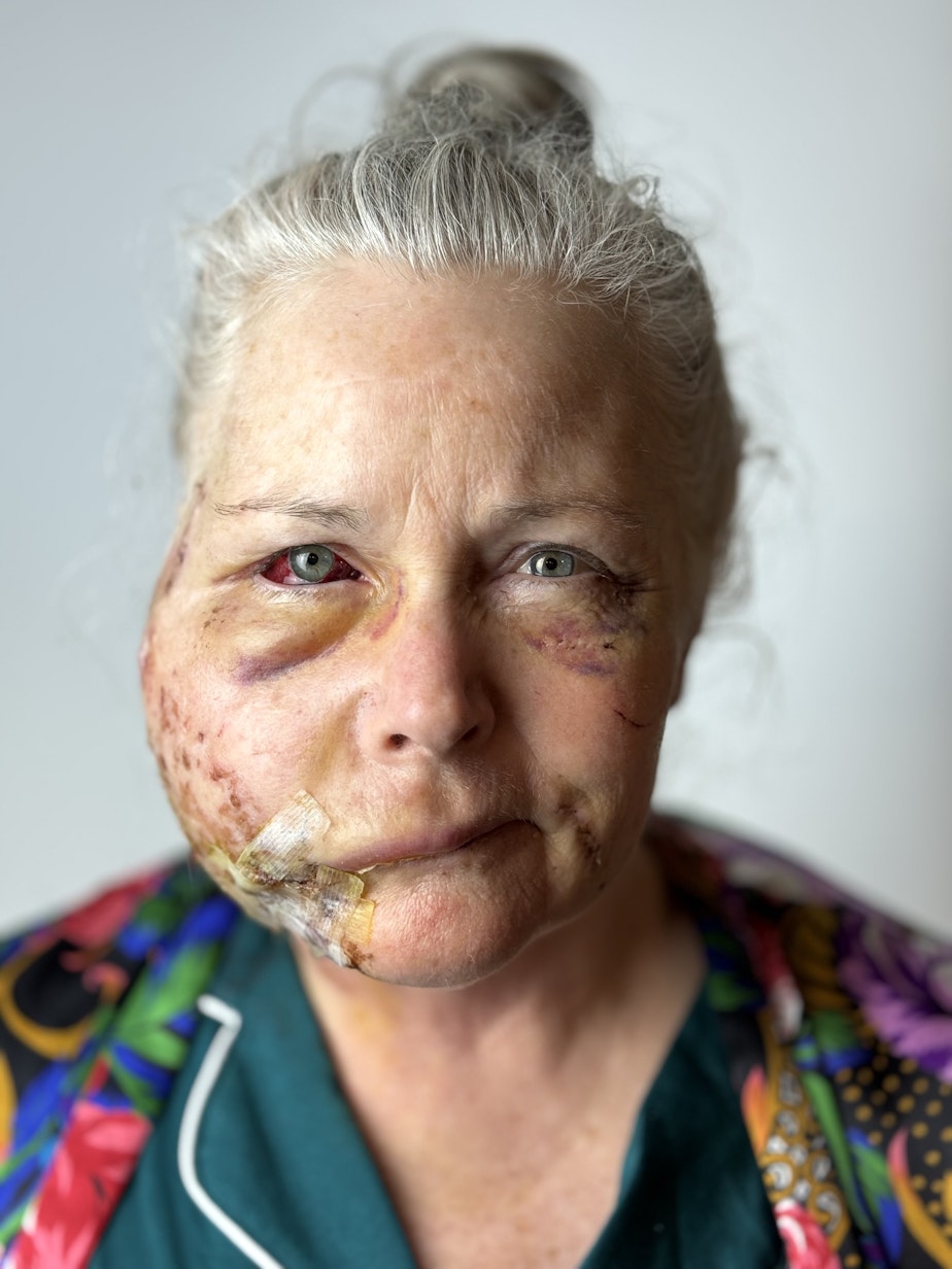 caption: Keri Bergere, 60, the day after she was attacked by a cougar on a bike trail north of Snoqualmie in Washington state, on February 17, 2024.