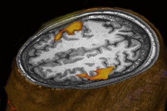 caption: An MRI scan of a person listening to music shows brain areas that respond. (This scan wasn't part of the research comparing humans and monkeys.)