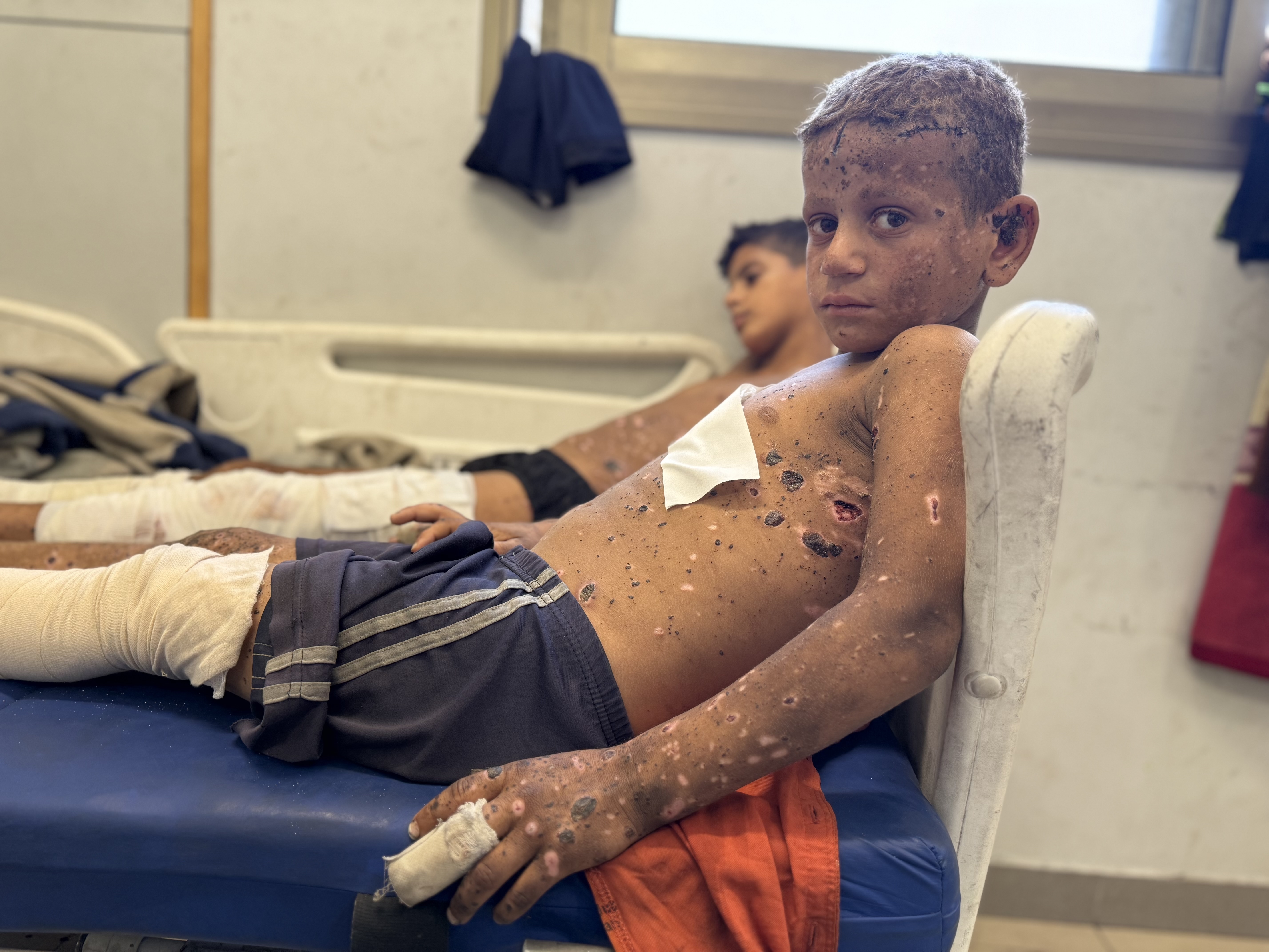 caption: Joud Ahmad Al-Angar (right) and his 12-year-old cousin Zain Nour recuperate from injuries after they found a bucket of pellets and brought it home, thinking it could help their family. The bucket detonated.