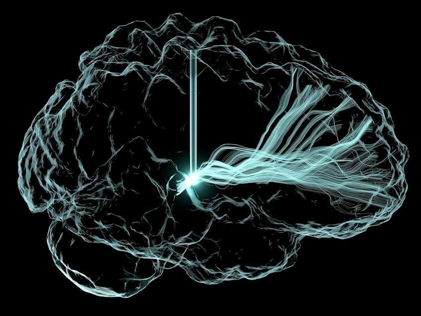 caption: An artistic rendering of deep brain stimulation. Scientists are studying this approach to see if it can treat cognitive impairment that can arise after a traumatic brain injury and other conditions.