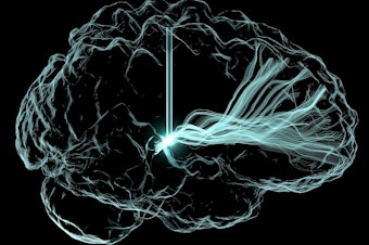 caption: An artistic rendering of deep brain stimulation. Scientists are studying this approach to see if it can treat cognitive impairment that can arise after a traumatic brain injury and other conditions.