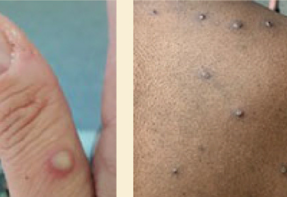 caption: Examples of a monkeypox (MPV) rash. 