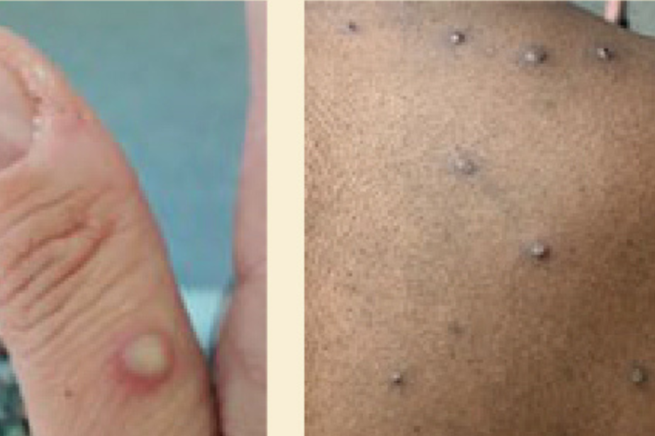 caption: Examples of a monkeypox (MPV) rash. 