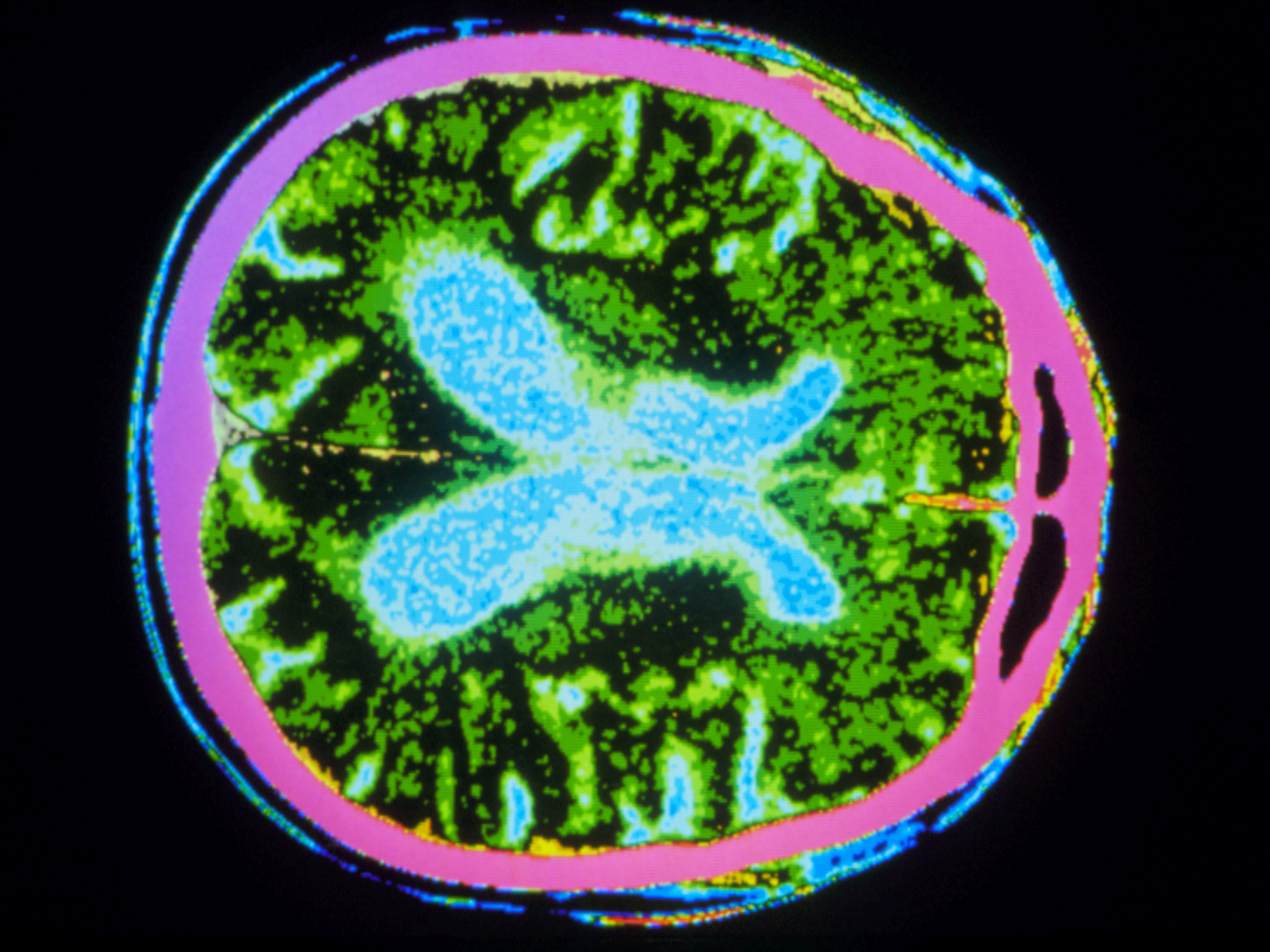 caption: A study finds some evidence that a cancer drug, nilotinib, may help people with Parkinson's disease, a nervous system disorder that causes movement problems. It possibly works by raising levels of dopamine, the brain chemical that is lacking in people with the disease.