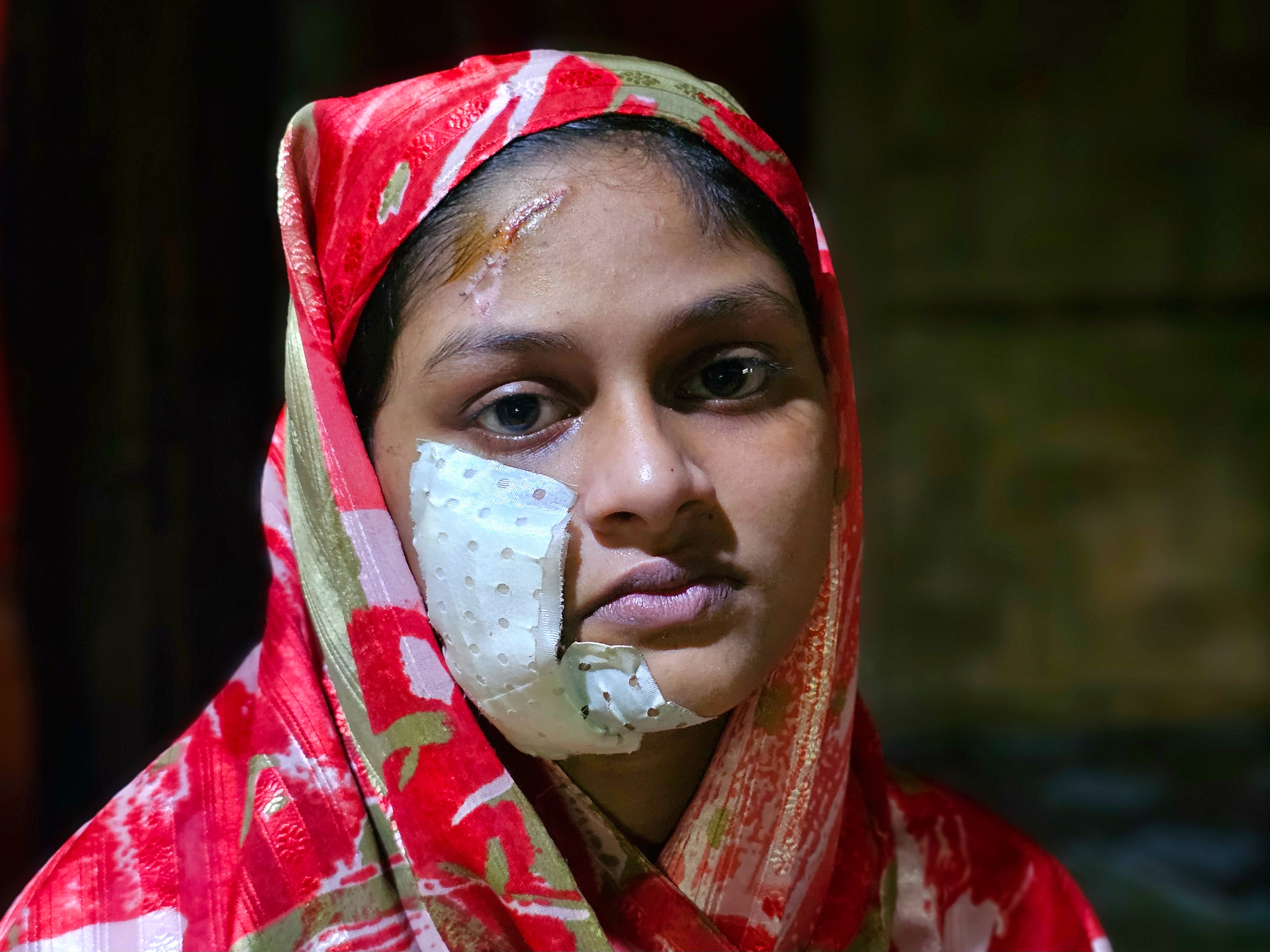 caption: Raashida, 15, says she was injured in her family's home in Rakhine State, Myanmar, on August 7 in a drone attack by the Arakan Army. Her mother and one sibling also sustained injuries. According to Amnesty International, "Rohingya civilians are now caught in the middle of intensifying conflict in Rakhine State between the Arakan Army and the Myanmar military." Raashida's family has fled Myanmar for Bangladesh, where nearly 1 million Rohingya refugees live in camps, having left their homes due to anti-Muslim