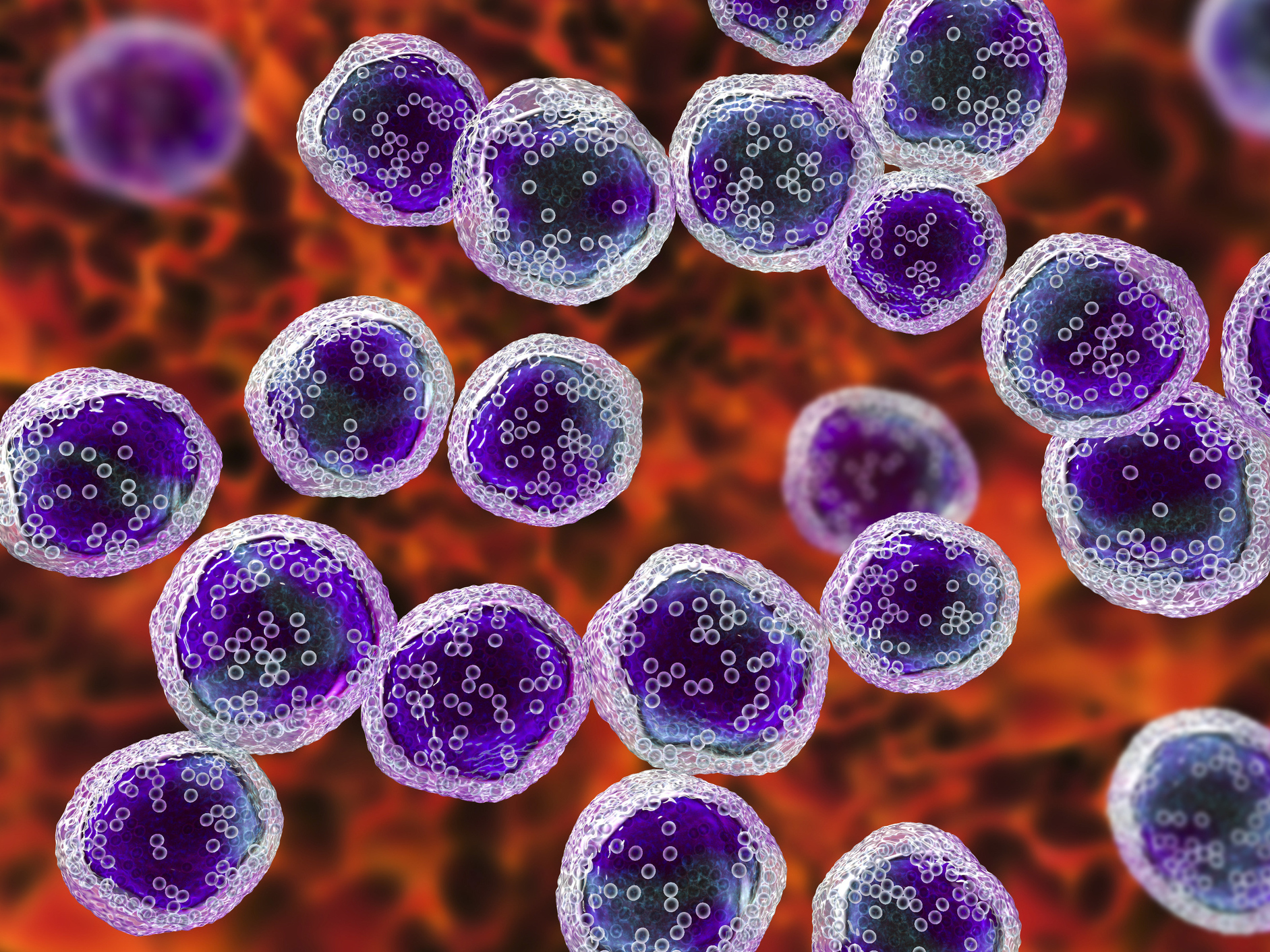 caption: Computer illustration of malignant B-cell lymphocytes seen in Burkitt's lymphoma, the most common childhood cancer in sub-Saharan Africa.