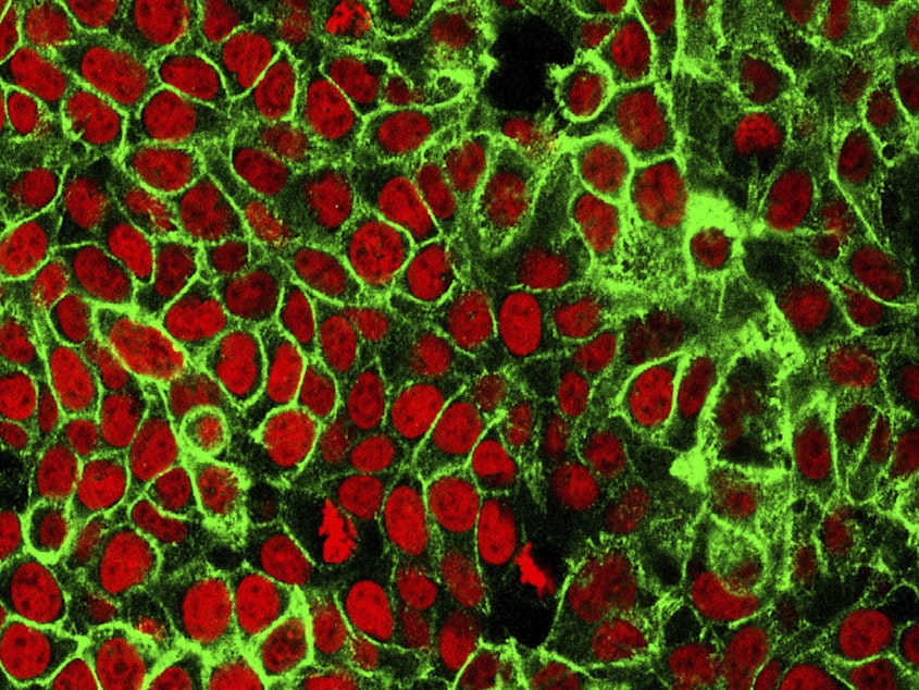caption: This microscope image from the National Cancer Institute Center for Cancer Research shows human colon cancer cells with the nuclei stained red. Americans should start getting screened for colon cancer at age 45, according to new guidelines from the U.S. Preventive Services Task Force.
