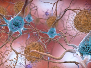 caption: This illustration made available by the National Institute on Aging/National Institutes of Health depicts cells in an Alzheimer's-affected brain. An experimental drug modestly slowed the brain disease's progression, researchers reported Tuesday.
