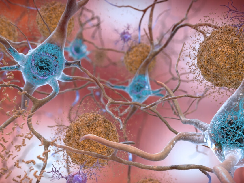 caption: This illustration made available by the National Institute on Aging/National Institutes of Health depicts cells in an Alzheimer's-affected brain. An experimental drug modestly slowed the brain disease's progression, researchers reported Tuesday.