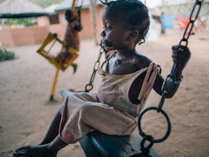 caption: A young girl in the courtyard of Nigeria's Sokoto Noma Hospital. She arrived with her mother for reconstructive operations, including a skin graft taken from her chest to replace tissue destroyed by noma.