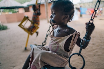 caption: A young girl in the courtyard of Nigeria's Sokoto Noma Hospital. She arrived with her mother for reconstructive operations, including a skin graft taken from her chest to replace tissue destroyed by noma.