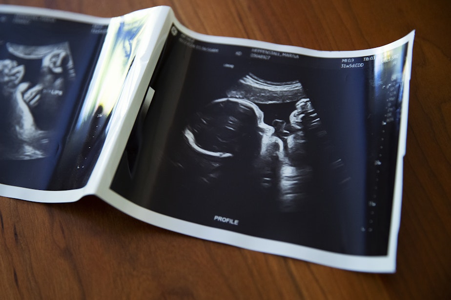 caption: An ultrasound image of Marina Heppenstall and Skyler Vella’s baby Arlo is shown on Tuesday, July 16, 2024, at their home on Bainbridge Island.