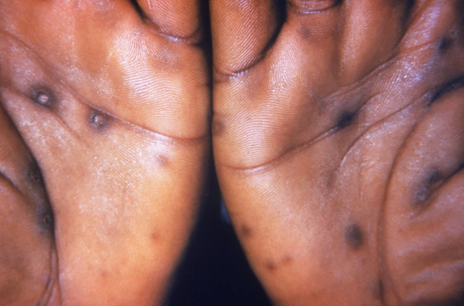 caption: A close up of a rash caused by a syphilis infection. 