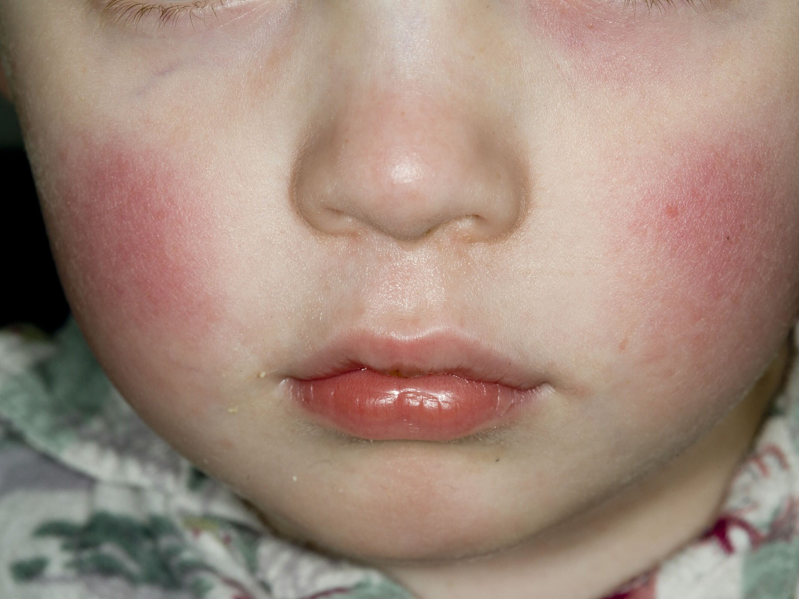 caption: A parvovirus B19 infection can cause a facial rash in children, which is why the disease caused by the virus is sometimes called "slapped-cheek disease."